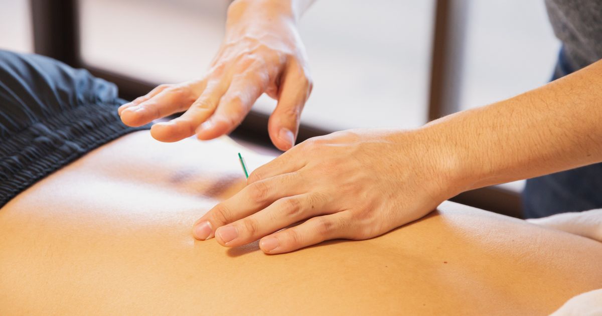 Acupuncturist placing a fine needle in a patient's lower back during a treatment session